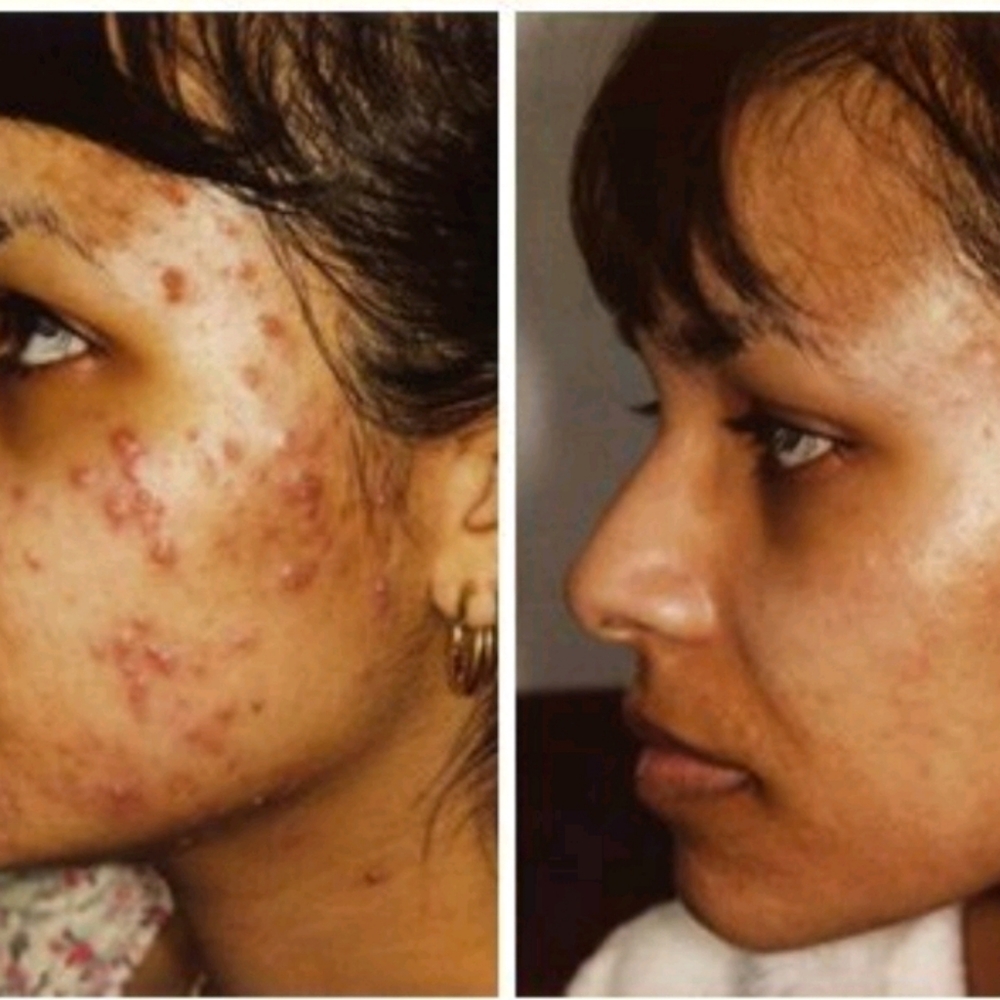 Acne Remover